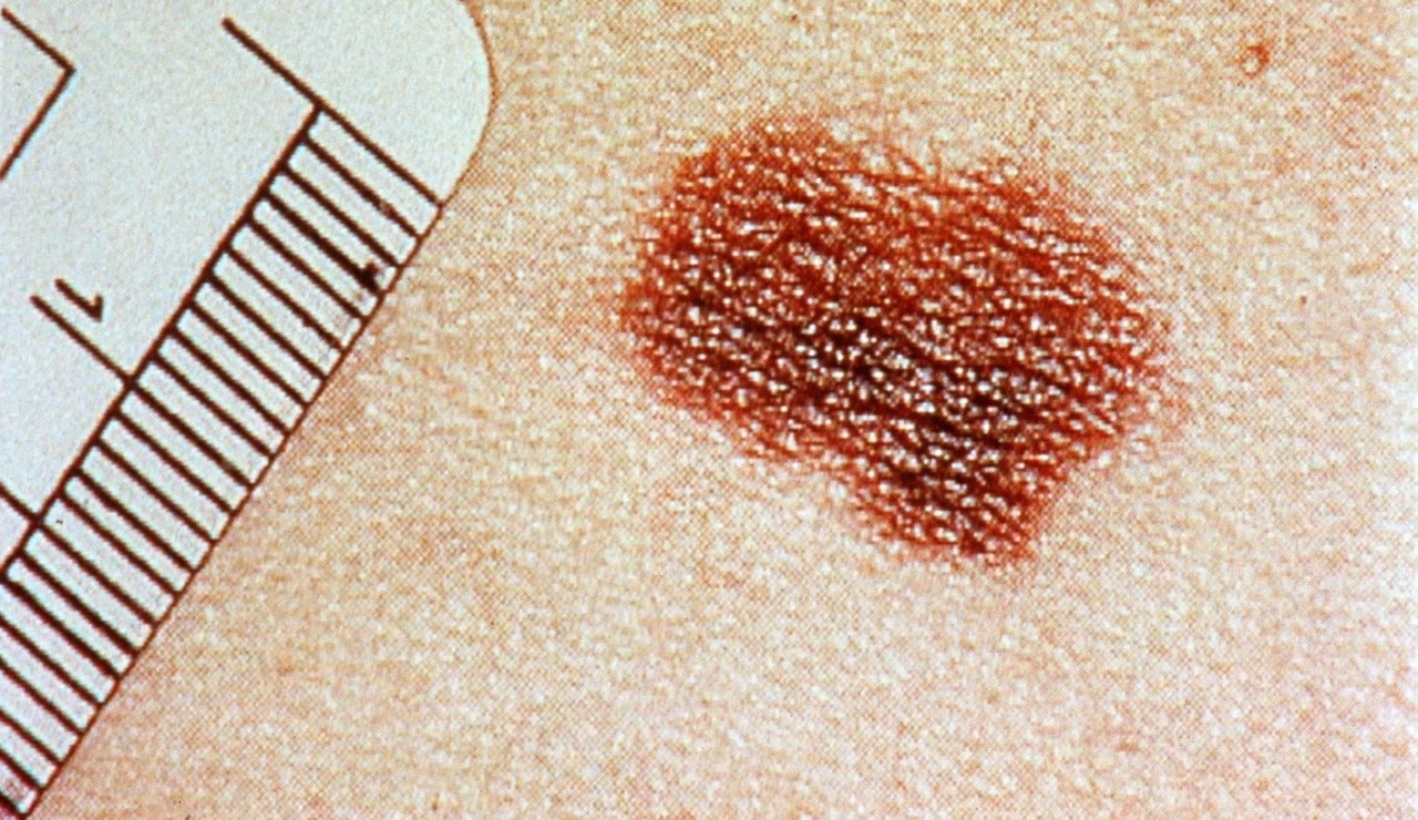 Melanoma