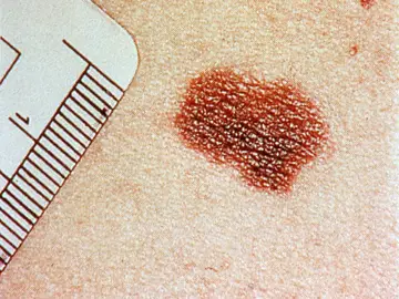 Melanoma Melanoma
