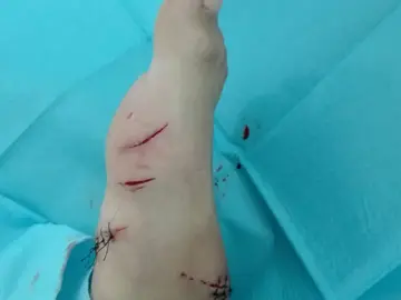 Heridas en el pie que presenta el niño Heridas en el pie que presenta el niño
