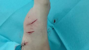 Heridas en el pie que presenta el niño