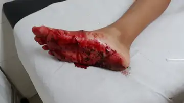 Heridas en el pie que presenta el niño Heridas en el pie que presenta el niño