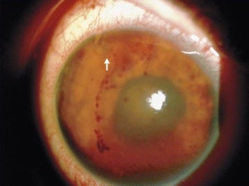 El parásito localizado en el globo ocular por los médicos