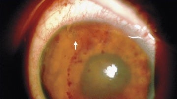 El parásito localizado en el globo ocular por los médicos