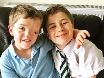 Harry, el niño con una desfiguración facial, junto a su hermano gemelo Harry, el niño con una desfiguración facial, junto a su hermano gemelo