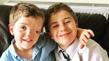Harry, el niño con una desfiguración facial, junto a su hermano gemelo