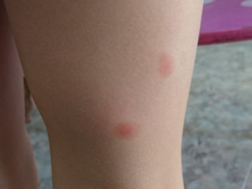 Picaduras de pulga en la pierna de un niño