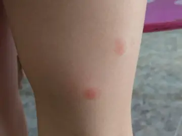 Picaduras de pulga en la pierna de un niño Picaduras de pulga en la pierna de un niño