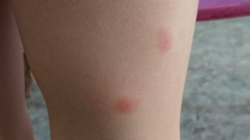 Picaduras de pulga en la pierna de un niño