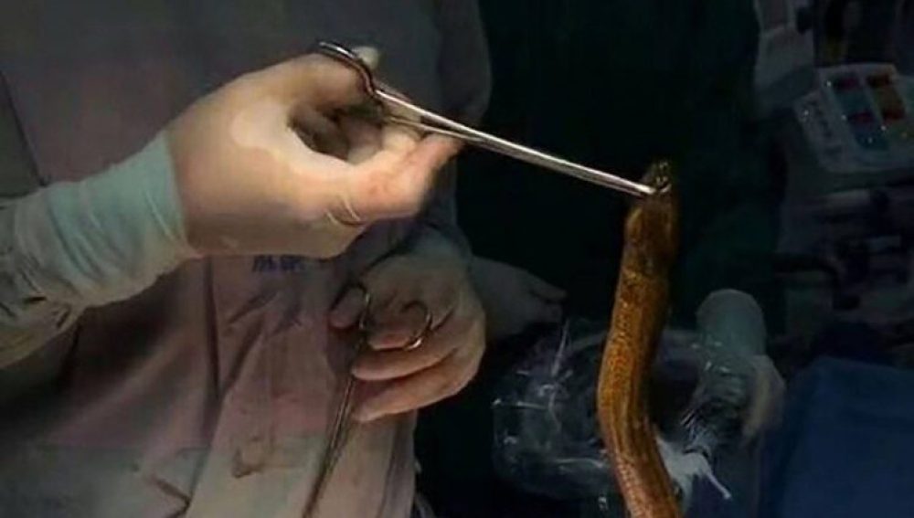 La anguila que extrajeron del abdomen del hombre