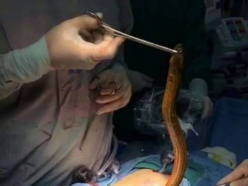 La anguila que extrajeron del abdomen del hombre