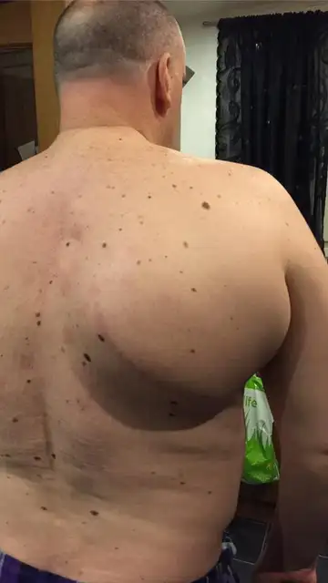 Imagen del tumor que aquejaba a Kevin Imagen del tumor que aquejaba a Kevin