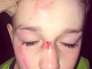 Las heridas que le hicieron al pequeño Las heridas que le hicieron al pequeño