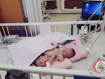 Gemelos siameses palestinos Gemelos siameses palestinos