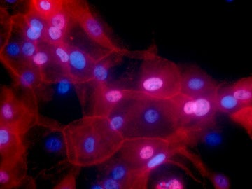 Células de cáncer de mama cultivadas en laboratorio