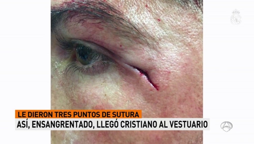 Imagen inédita: la brecha de Cristiano Ronaldo, a medio centímetro del ojo izquierdo