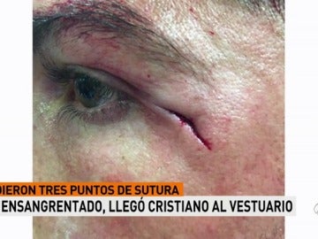 Imagen inédita: la brecha de Cristiano Ronaldo, a medio centímetro del ojo izquierdo