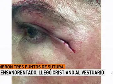 Imagen inédita: la brecha de Cristiano Ronaldo, a medio centímetro del ojo izquierdo Imagen inédita: la brecha de Cristiano Ronaldo, a medio centímetro del ojo izquierdo