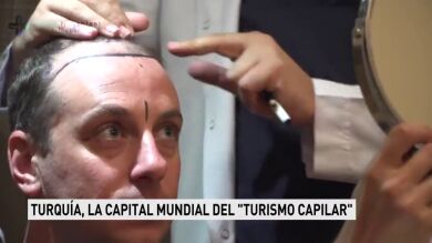Más de 10.000 españoles viajan anualmente a Turquía para hacerse un implante capilar , país : reclamo mundial del turismo capilar