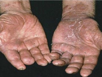 Las manos de un enfermo de lepra 