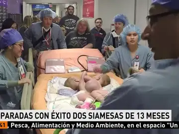 Imagen de las dos hermanas siamesas separadas en EEUU Imagen de las dos hermanas siamesas separadas en EEUU