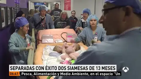 Imagen de las dos hermanas siamesas separadas en EEUU Imagen de las dos hermanas siamesas separadas en EEUU