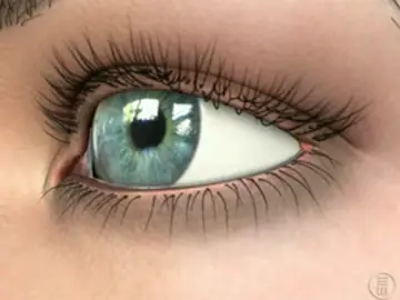 Glaucoma Glaucoma