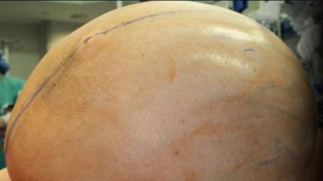 Imagen del tumor antes de la operación