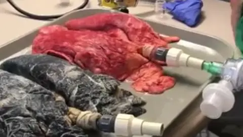 Comparativa del pulmón de un fumador y un pulmón sano Comparativa del pulmón de un fumador y un pulmón sano