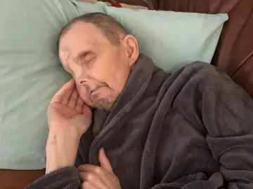 Danny Hunt, tras la extirpación de su ojo derecho y parte de su nariz Danny Hunt, tras la extirpación de su ojo derecho y parte de su nariz