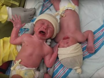 Los gemelos llorando tras nacer