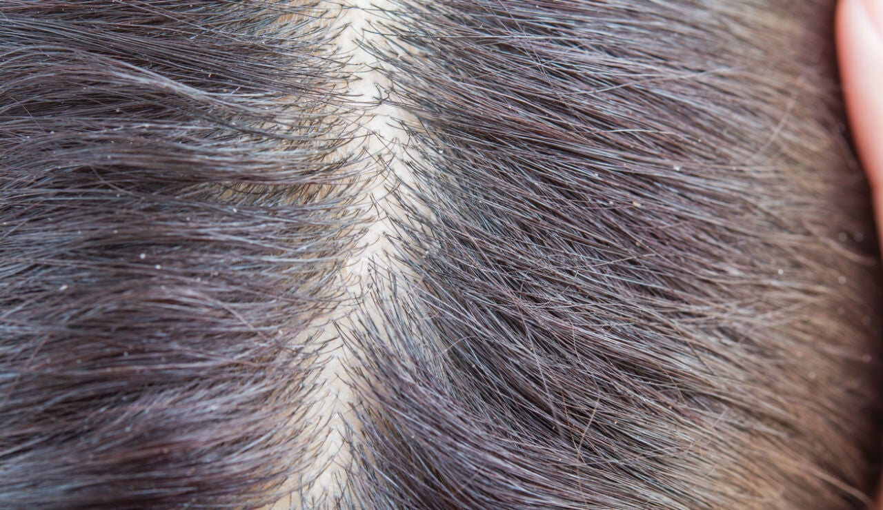 Pelo sucio