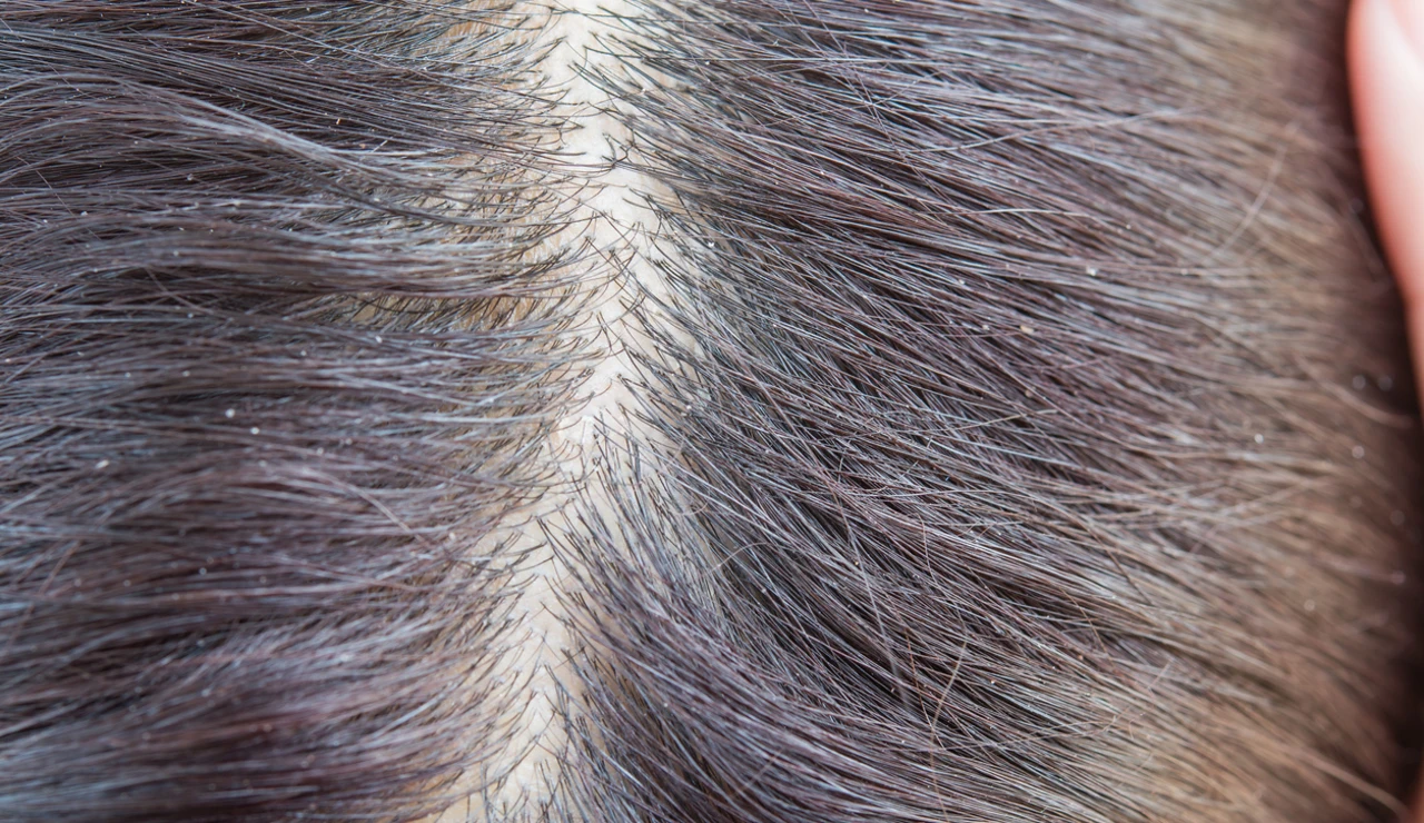 Pelo sucio