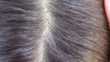 Pelo sucio