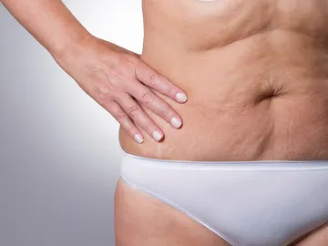 Flacidez en la zona del abdomen Flacidez en la zona del abdomen