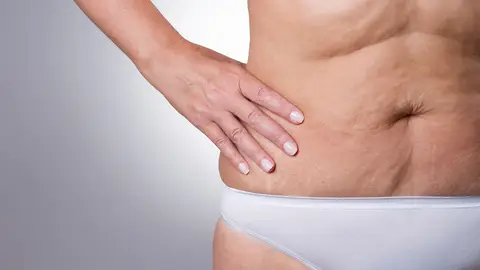 Flacidez en la zona del abdomen Flacidez en la zona del abdomen