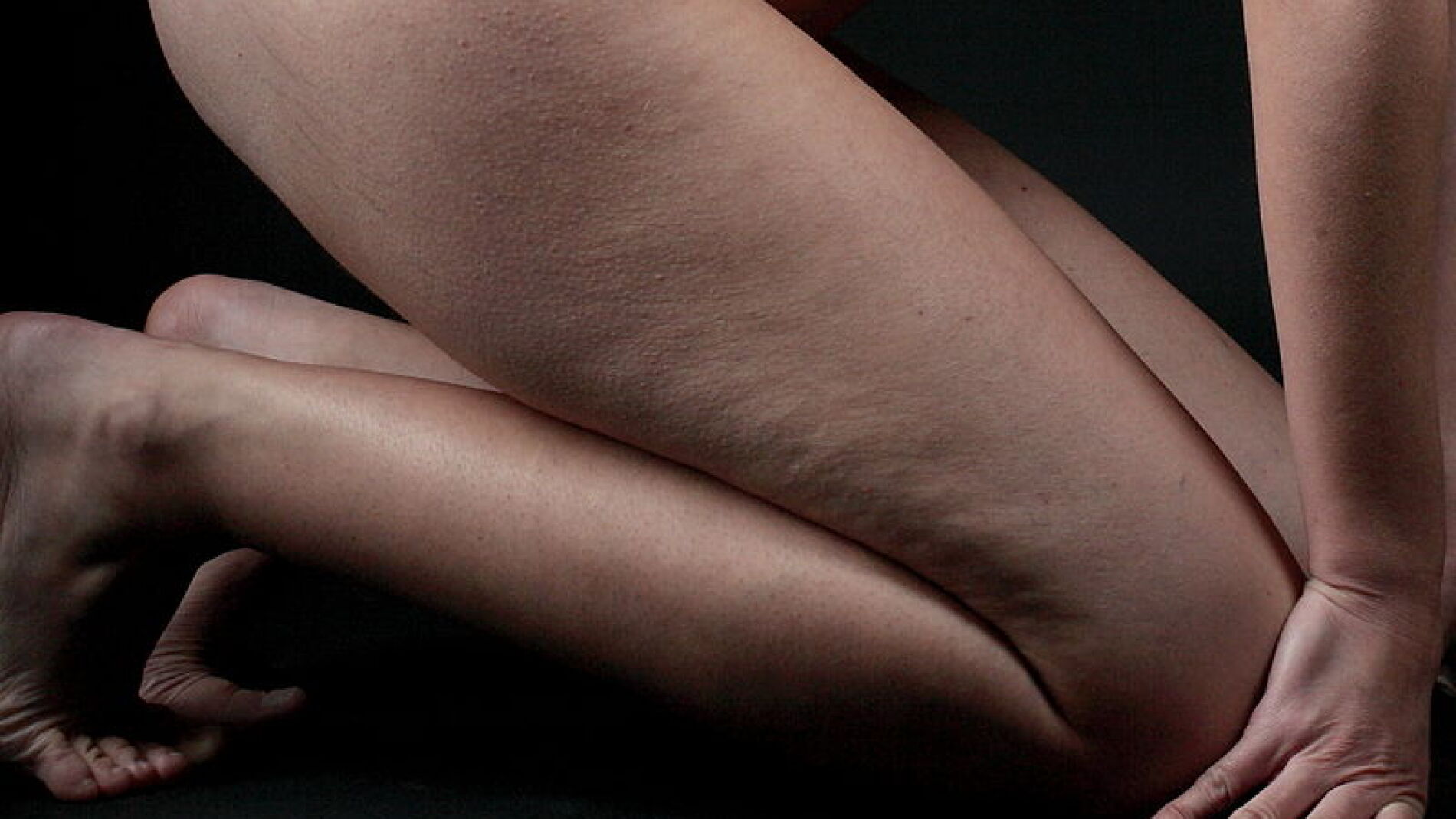 La celulitis se agrava con determinados alimentos.