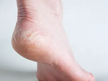 Talones agrietados en verano Talones agrietados en verano