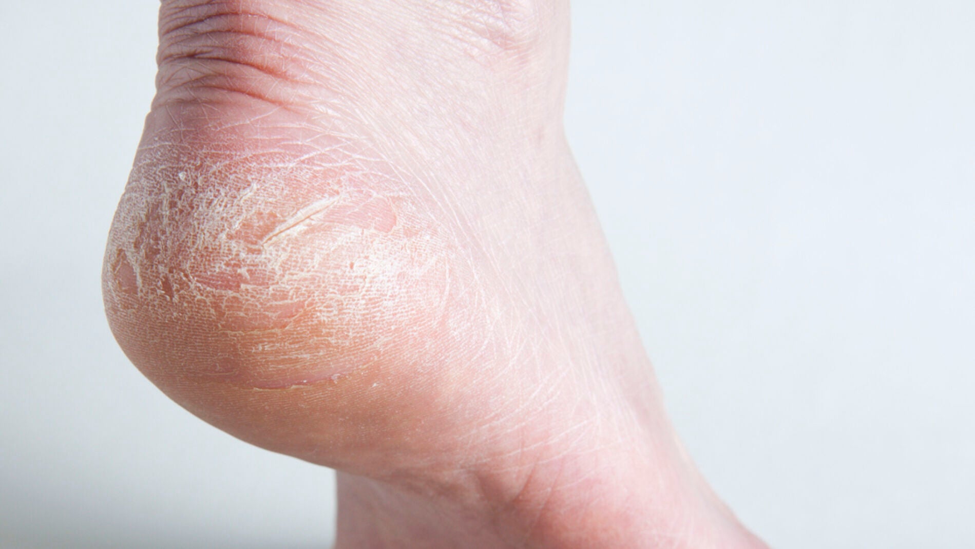 Talones agrietados en verano