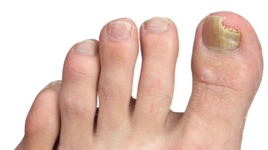 Hongos en las uñas de los pies