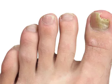 Hongos en las uñas de los pies Hongos en las uñas de los pies