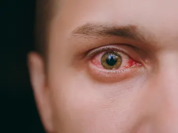 Ojos irritados Ojos irritados