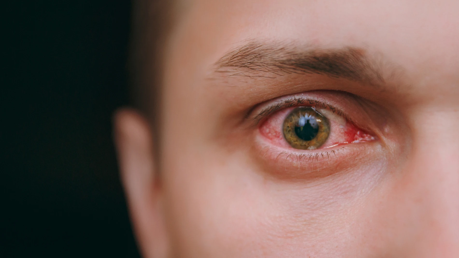 Ojos irritados Ojos irritados