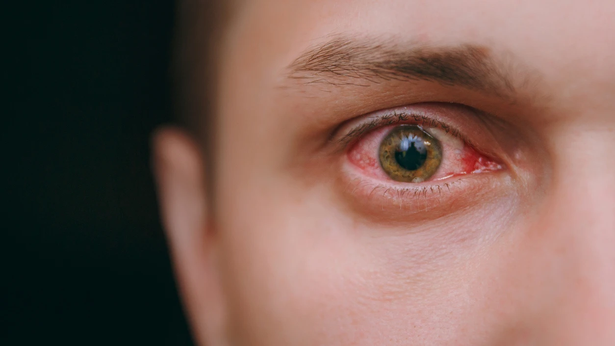 Ojos irritados Ojos irritados