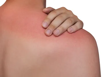 Quemadura solar en la espalda Quemadura solar en la espalda