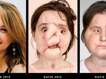 Trasplante de cara de Katie Stubblefield