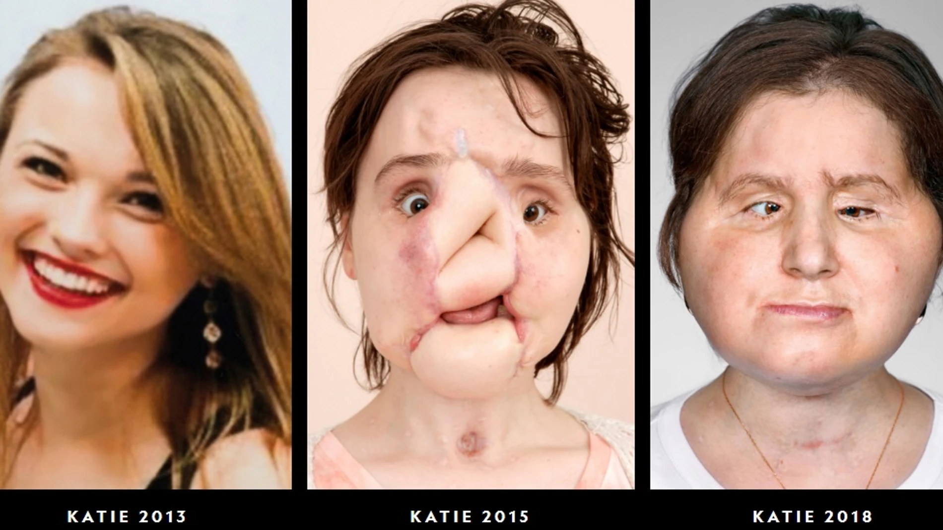 Trasplante de cara de Katie Stubblefield Trasplante de cara de Katie Stubblefield