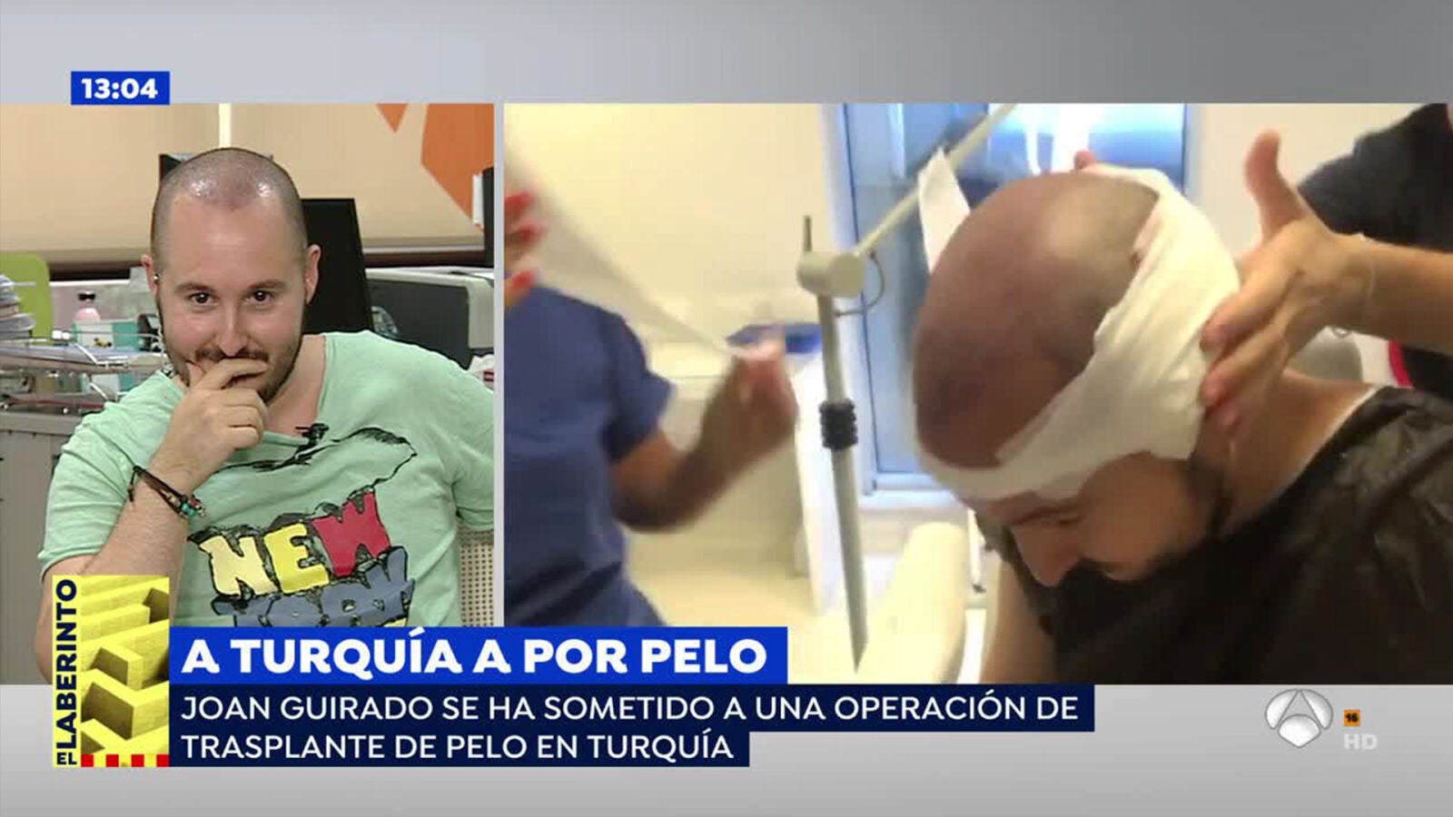 Joan Guirado, periodista de 'Espejo Público', nos muestra su trasplante de pelo en su viaje a Turquía