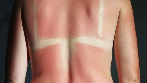 Marcas del sol Marcas del sol