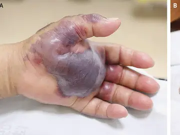 Grave infección en la mano por comer pescado crudo Grave infección en la mano por comer pescado crudo