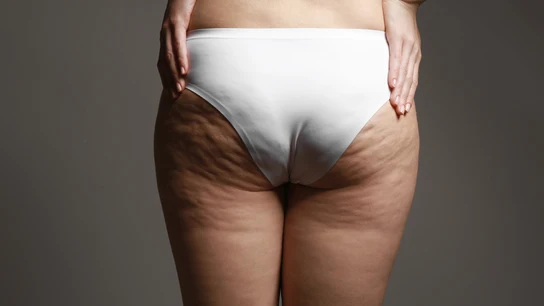 Celulitis Celulitis